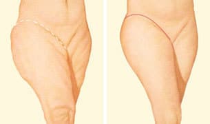 Foto de Lifting nas coxas