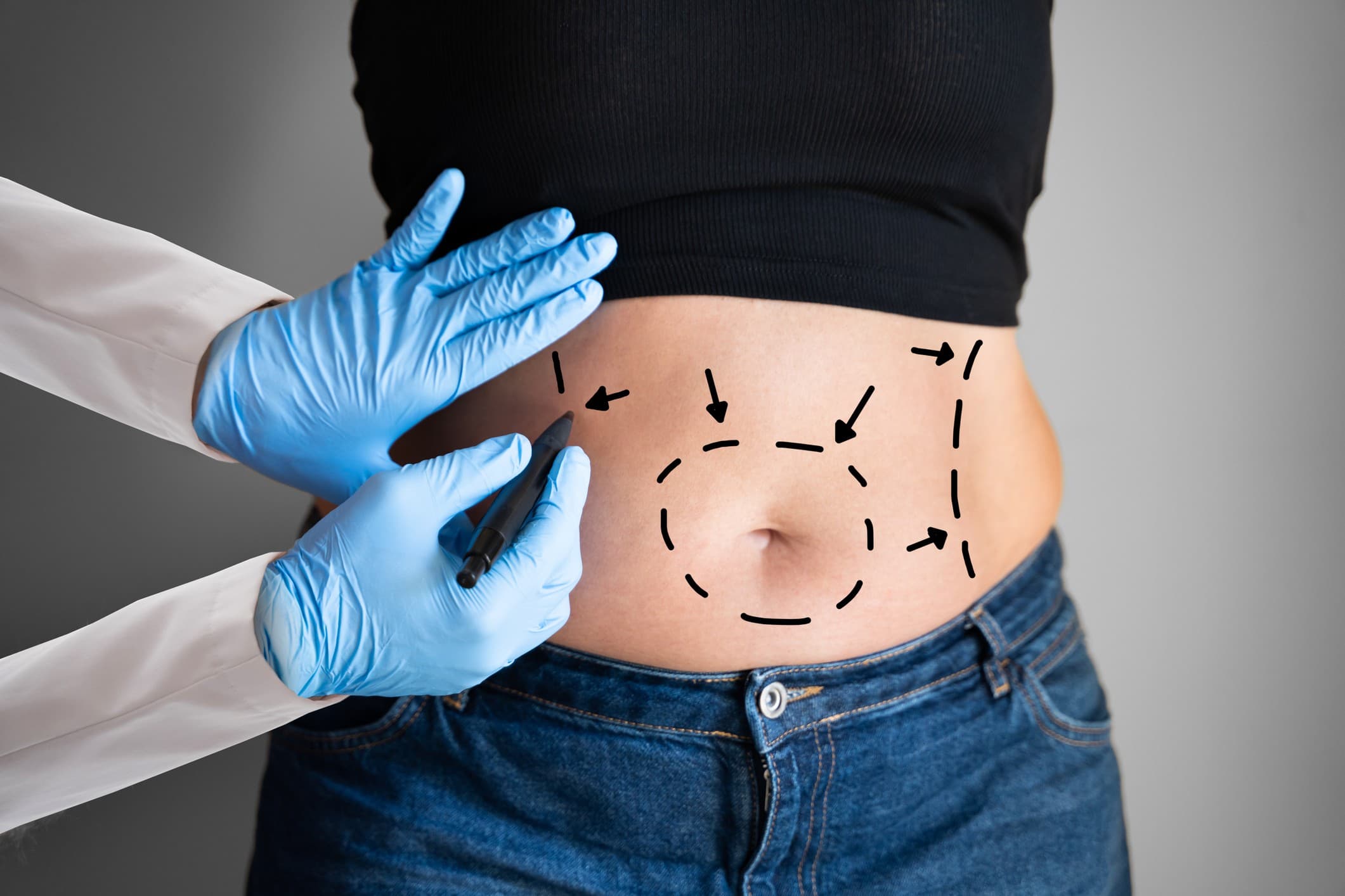 abdominoplastia