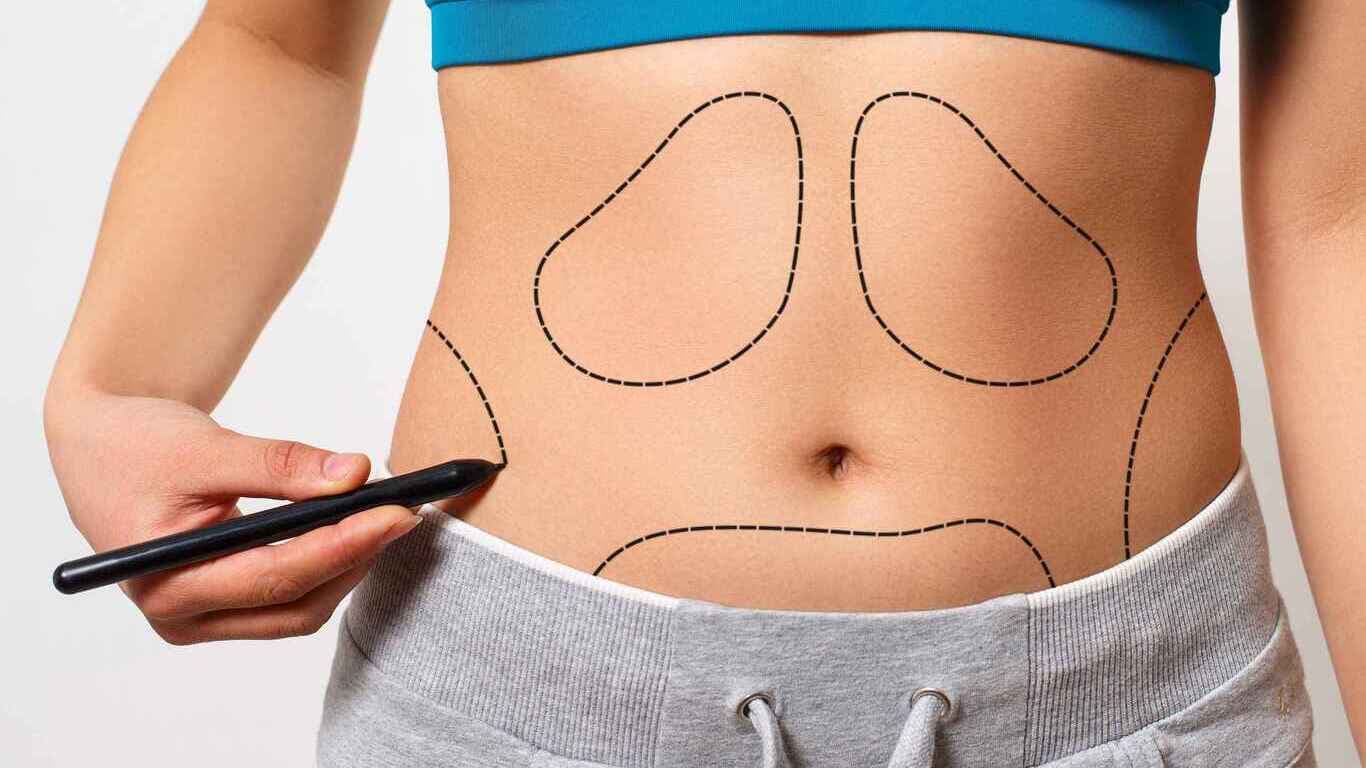 abdominoplastia com ou sem lipo