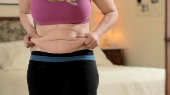 Abdominoplastia: dê adeus à flacidez