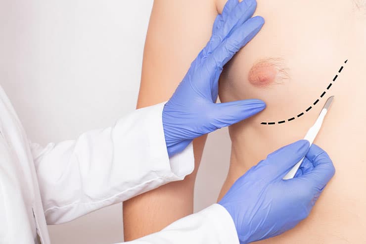descubra o que é e para que serve a cirurgia de ginecomastia