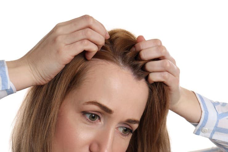 tipos de alopecia