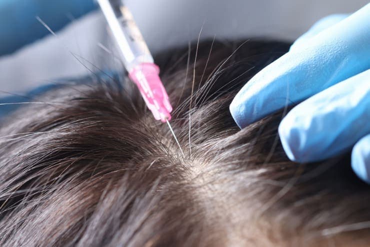 é necessário uso de medicamentos pós transplante capilarr?