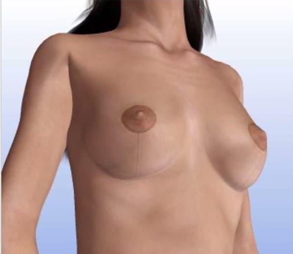 mamoplastia-redutora