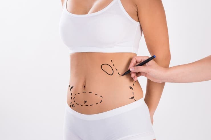 posso realizar a abdominoplastia novamente?