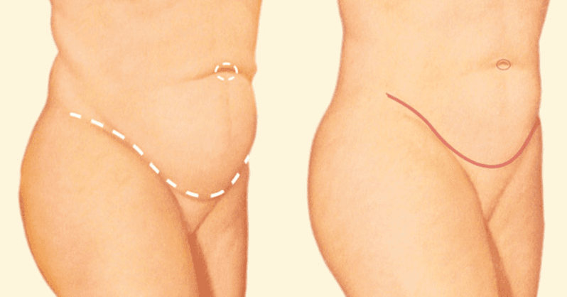 Tipos de Abdominoplastia e cicatrizações