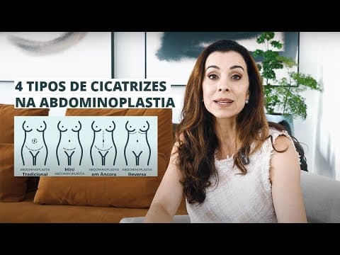 4 TIPOS DIFERENTES DE ABDOMINOPLASTIA