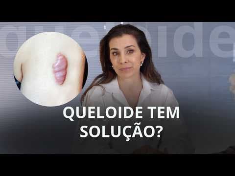 Cicatriz com queloide: O que fazer para tratar?