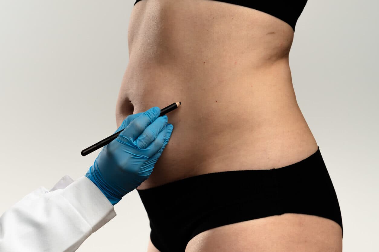 Cirurgião segurando um lápis prestes a fazer marcações no abdomên de uma paciente para a realização da abdominoplastia com lipo HD