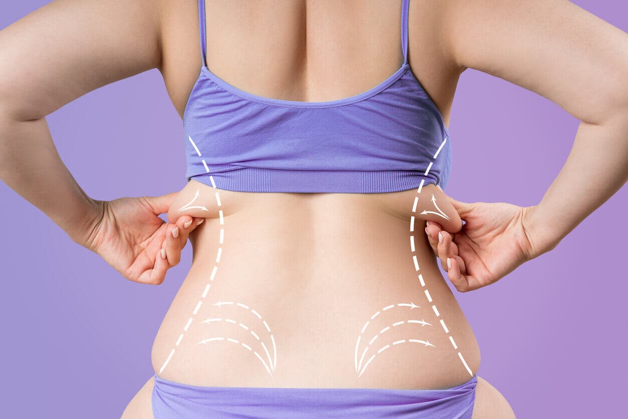 Fundo lilás com uma paciente do sexo feminino em evidência, segurando o excesso de gordura acima do abdômen, demonstrando ser uma possível candidata a abdominoplastia reversa