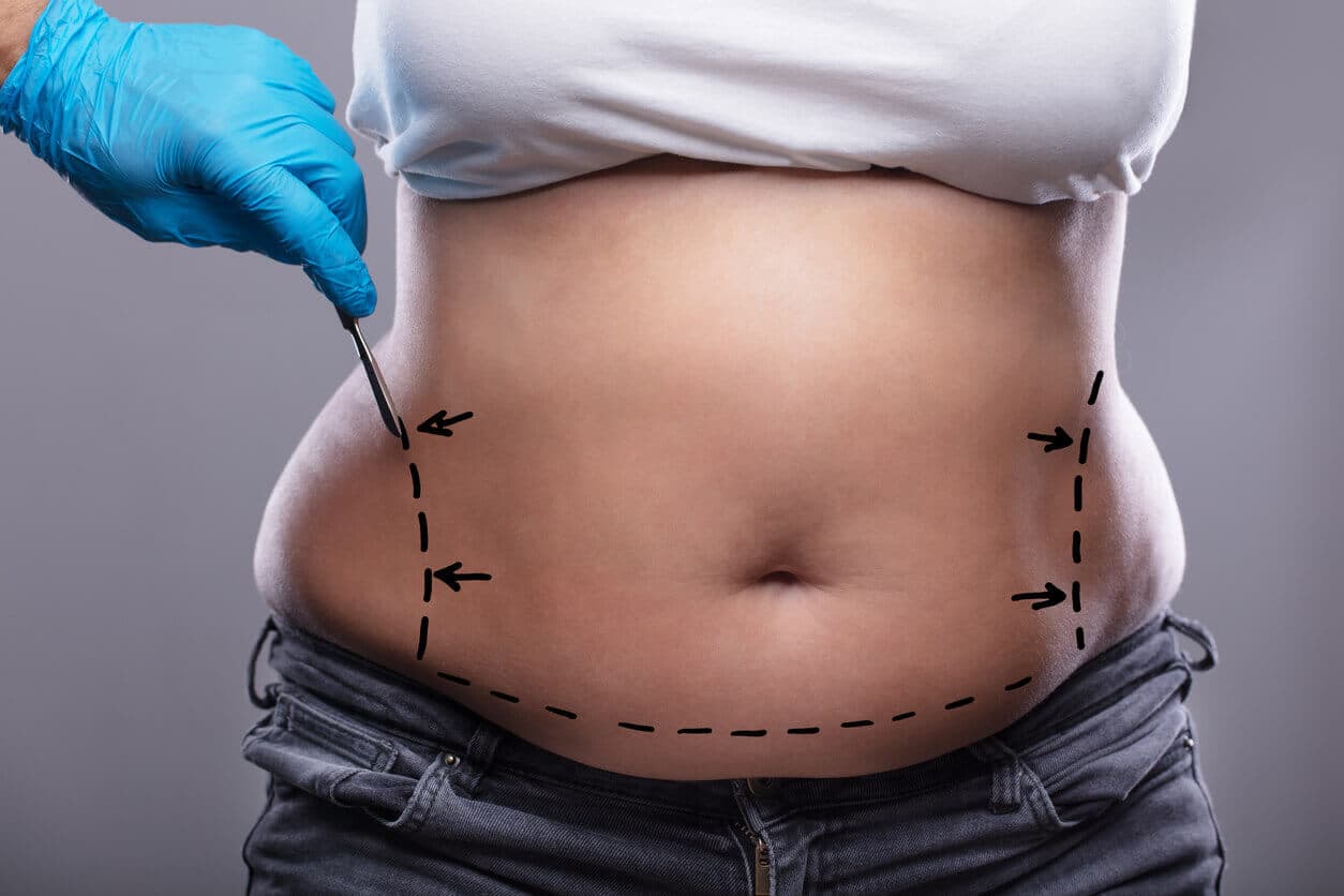 Torso e barriga de uma paciente sendo preparada para a cirurgia de lipoescultura, sinalizando o excesso de gordura a ser retirada