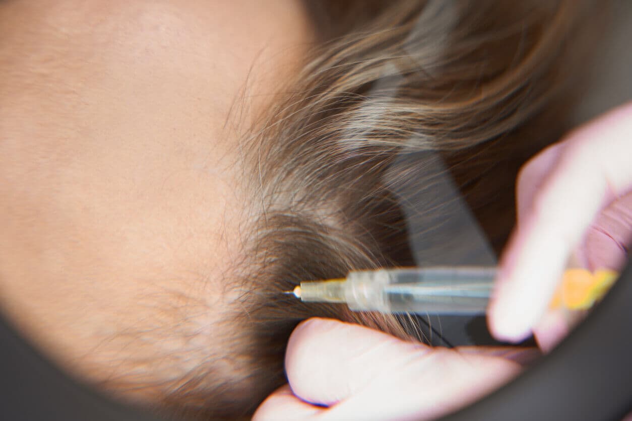 Cliente do sexo feminino em um procedimento de injeção durante uma sessão de intradermoterapia capilar