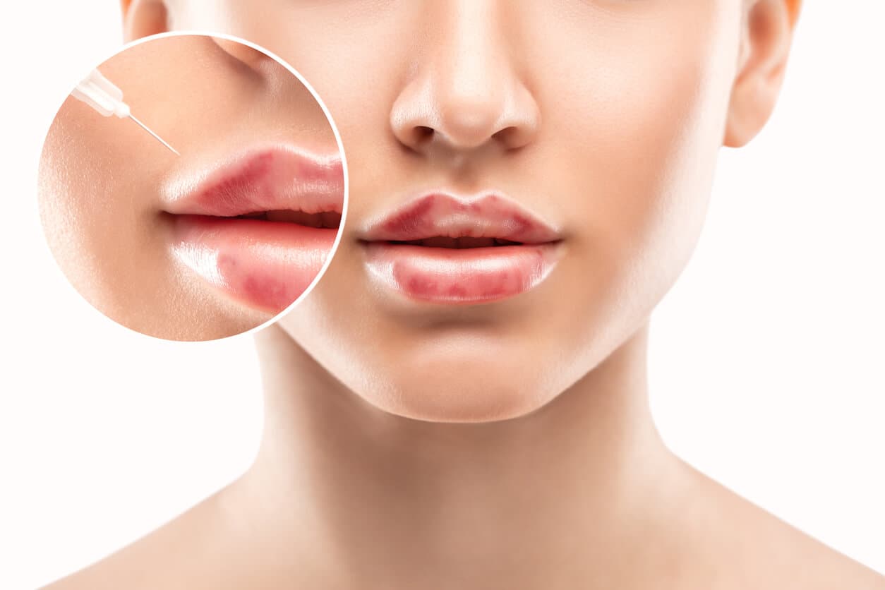 Close no rosto de uma mulher com preenchimento labial exagerado, destacando áreas marcadas e irregularidades visíveis nos lábios com aumento simétrico artificial.