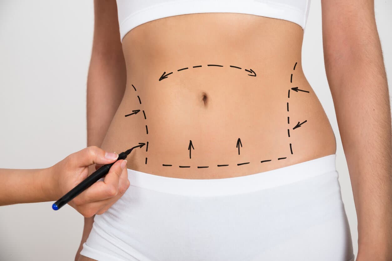 A mão de um médica realiza marcações no abdômen de uma paciente, preparando-a para uma cirurgia de barriga
