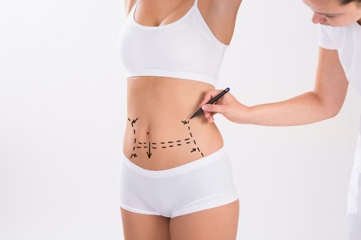 vantagens abdominoplastia a laser