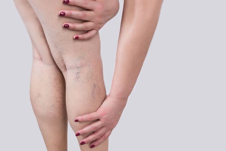 tratamentos lipedema