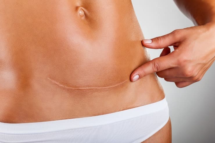 Descubra alguns mitos e verdades sobre cicatriz de cirurgia plástica