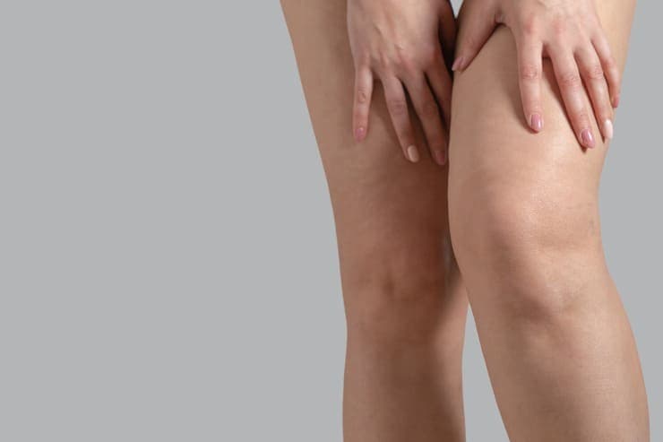 exercícios lipedema