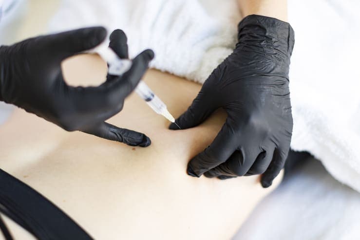 eficacia da mesoterapia