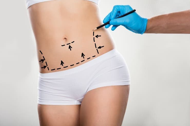 Conheça mais sobre a mini abdominoplastia