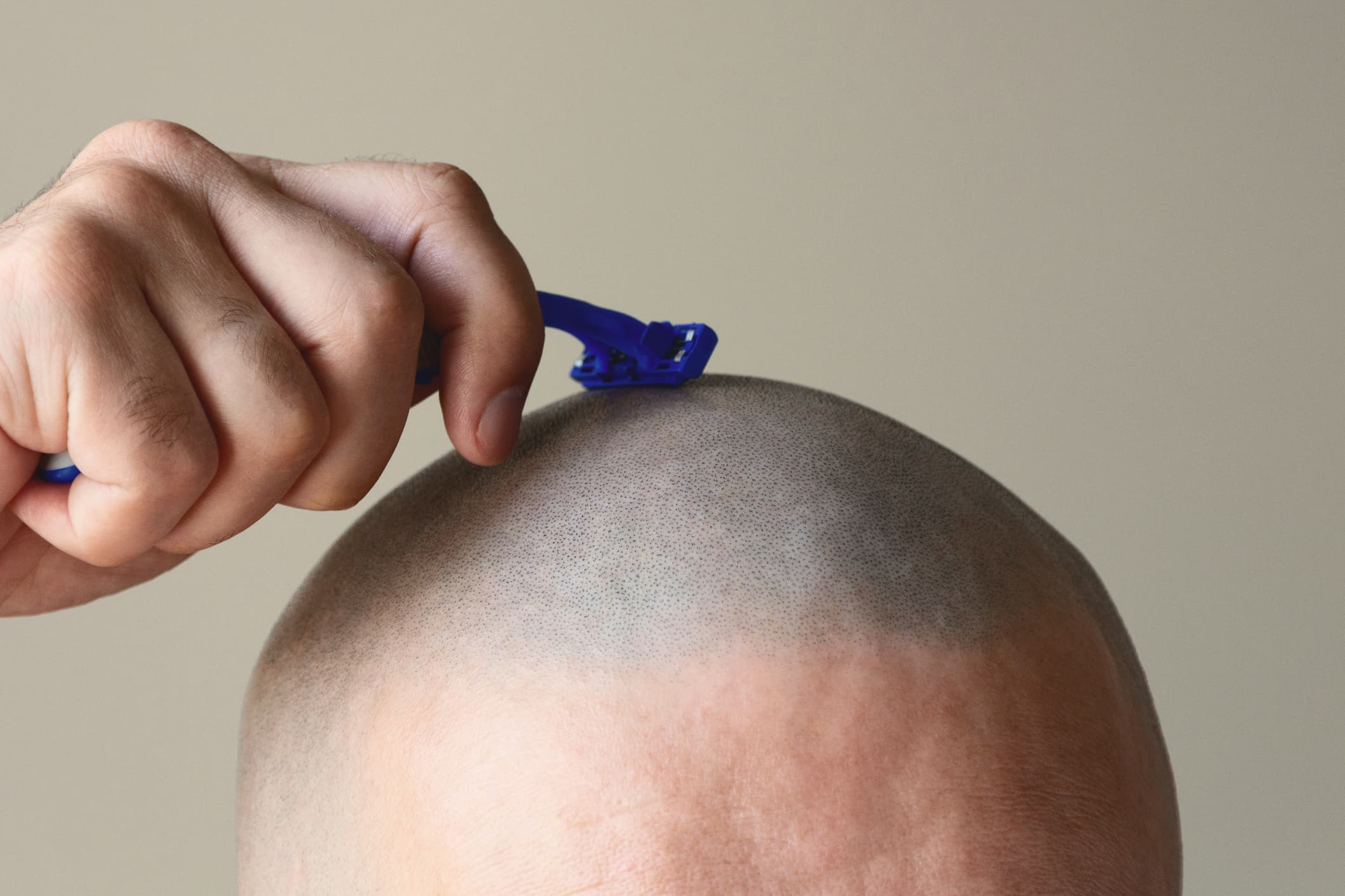 raspar a cabeça pra fazer transplante capilar