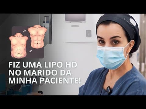 Lipo HD Masculina com Enxerto de Gordura no peito e deltoides